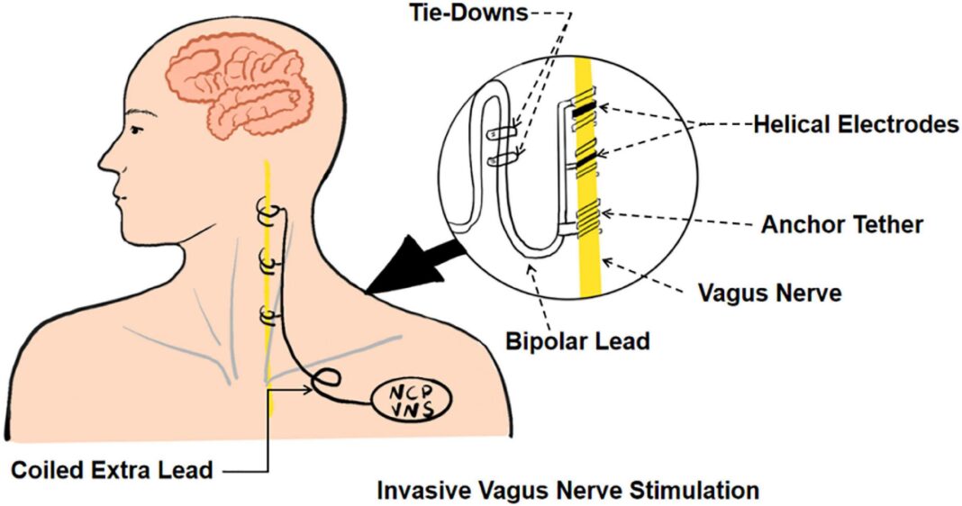 The Role of Vagus Nerve Stimulation (Simple, Non Invasive Methods) (1)