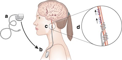 The Role of Vagus Nerve Stimulation (Simple, Non Invasive Methods) (2)