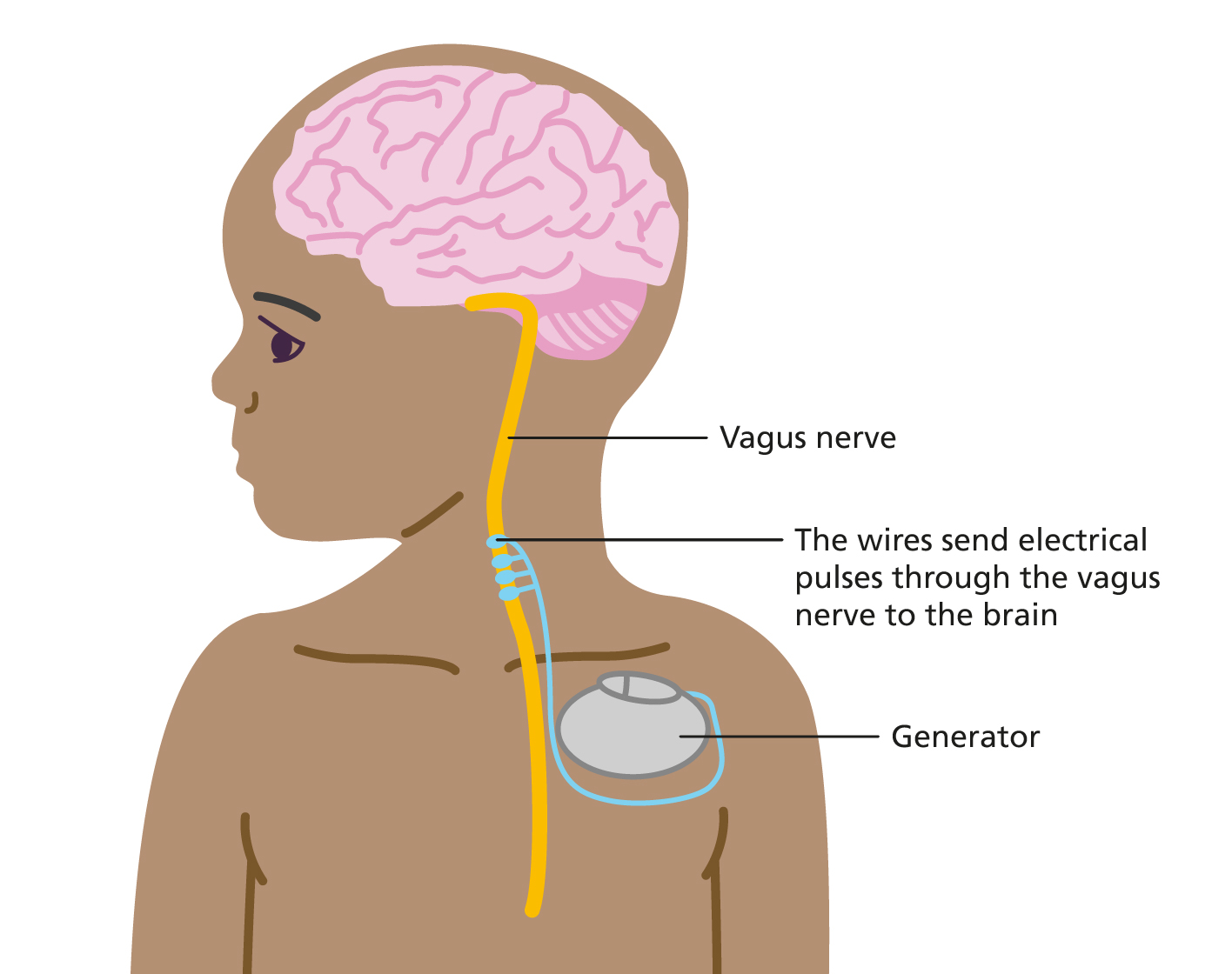The Role of Vagus Nerve Stimulation (Simple, Non Invasive Methods) (3)